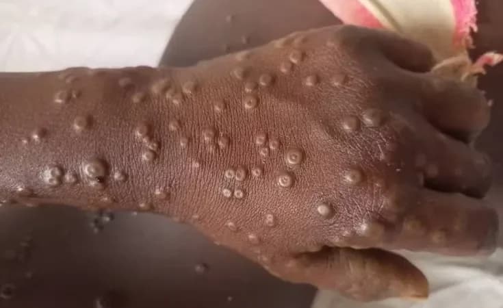 WHO declares Mpox outbreak a public health emergency of international concern