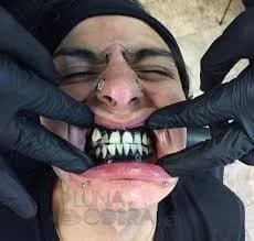 Beauty comes with risks: Negative effects of gum tattoo