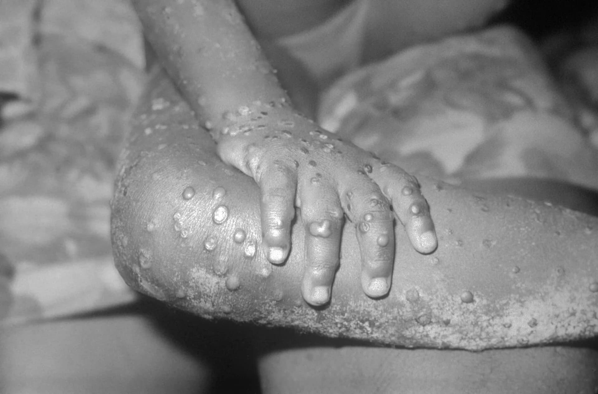 Byinshi wamenya kundwara ya mpox ikomeje kwibasira bimwe mubihugu by'Afurika.